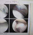 Osteoarthritis is characterized by impairment of cartilage and subchondral bone. In this image, an example of damaged knee cartilage is shown.