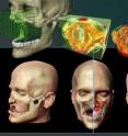 Using engineering design methods, researchers model custom bone replacement implants for facial reconstruction surgery. Using engineering design methods, researchers model custom bone replacement implants for facial reconstruction surgery.