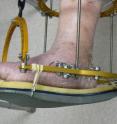 A device called a circular external fixator secures foot bones following surgery for Charcot foot.