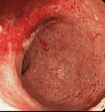 This image from a colonoscopy shows a section of the bowel affected with severe ulcerative colitis.