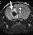 Iron oxide nanoparticles “darken” the MRI signal of a brain tumor implanted into a mouse.