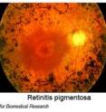 A retina with the degenerative vision disease, retinitis pigmentosa (right) is compared to a healthy retina.