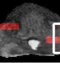 This is an MRI image of prostate gland, with red regions indicating high-grade prostate cancer based on Rutgers image analysis techniques. The area inside the white outline was confirmed as high-grade cancer by analyzing surgically removed gland.
