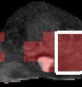 This is an MRI image of prostate gland, with red regions indicating presence of prostate cancer based on Rutgers image analysis techniques. The area inside the white outline was confirmed as cancerous by analyzing surgically removed gland.