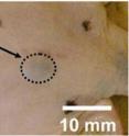 This skin tumor is shown after treatment with a new contrast agent that can improve the visualization of skin cancer cells using an advanced medical imaging device.