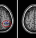The circled portion of the older adult's brain on the left indicates the cross-talk between the two hemispheres that is not apparent in the younger brain on the right.