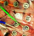 This photo shows two kinds of electrodes sitting atop a severely epileptic patient's brain after part of his skull was removed temporarily. The larger, numbered, button-like electrodes are ECoGs used by surgeons to locate and then remove brain areas responsible for severe epileptic seizures. While the patient had to undergo that procedure, he volunteered to let researchers place two small grids -- each with 16 tiny "microECoG" electrodes -- over two brain areas responsible for speech. These grids are at the end of the green and orange wire bundles, and the grids are represented by two sets of 16 white dots since the actual grids cannot be seen easily in the photo. University of Utah scientists used the microelectrodes to translate speech-related brain signals into actual words -- a step toward future machines to allow severely paralyzed people to speak.