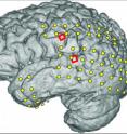 This magnetic resonance image (MRI) of an epileptic patient's brain is superimposed with the locations of two kinds of electrodes: conventional ECoG electrodes (yellow) to help locate the source of his seizures so surgeons could operate to prevent them, and two grids (red) of 16 experimental microECoG electrodes used to read speech signals from the brain. University of Utah scientists used the microelectrodes to translate brain signals into words -- a step toward devices that would let severely paralyzed people speak.