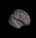 These are views of inflated cortical surface showing areas of brain gray matter correlating with
introspective accuracy.