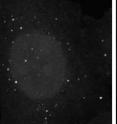 An abundance of alpha-synuclein (right) reduces the number of autophagosomes (bright puncta, left), the double-membraned vesicles that remove trash from the cell. Blocking autophagosome formation in this way may contribute to neurodegeneration in Parkinson’s patients.