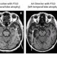 FTLD patients with professions ranked highly for verbal skills, such as chief executive, showed atrophy in right temporal lobe. In those with professions ranked lower for verbal skills, such as art director, atrophy was identified in left temporal lobe.