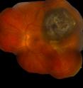 A cancerous melanoma tumor (dark area, upper right) is seen below the retina.