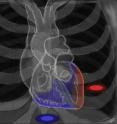 This is a schematic of the heart showing the minimally invasive approaches to allow access to the surface of the heart (the blue and red areas) during this hybrid cardiac procedure.