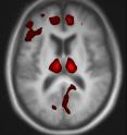 In this magnetic resonance imaging scan, the colored areas are brain regions that experienced changes in blood flow after patients received the investigational drug SYN115. In this magnetic resonance imaging scan, the colored areas are brain regions that experienced changes in blood flow after patients received the investigational drug SYN115.