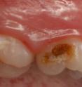The dark stained decay is irreversible loss of tooth tissue that must be repaired with dental treatment. The white patch on the tooth is an earlier stage of decay which can be stopped without drilling and filling.