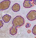 New technologies allow researchers to automate the typically manual identification (red boundaries) of potentially malignant regions in tissue samples of Follicular Lymphoma. The computer-aided process developed through the Ohio Supercomputer Center by a team of researchers at the Ohio State University delivers very accurate, highly consistent results in an efficient way (blue boundaries).
