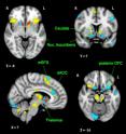 Brain activity of depressed and non-depressed mothers as they listen to their crying infants is highlighted in these fMRI scans.