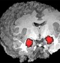 A new study supports the role of a brain region called the amygdala in processing anxiety. In this 3-D magnetic resonance imaging (MRI) rendering of a human brain, functional MRI (fMRI) activation of the amygdala is highlighted in red.