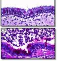 University of Iowa researchers have created a pig model that genetically replicates the most common form of cystic fibrosis. The pigs develop disease symptoms, including gastrointestinal abnormalities and lung disease, which mimic CF in humans. The image shows cells that line the bronchial airways of non-CF (top) and CF (bottom) pigs.  Hair-like cilia protrude from the tops of cells.  In non-CF, air fills the airway lumen above the cells.  In CF, inflammatory cells, mucus and bacteria sit in the airway lumen.  In CF, more of the airway cells have a reddish-purple color indicating increased mucus production.