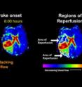 Scientists at Washington University School of Medicine in St. Louis have found evidence that statins, which are drugs used to lower cholesterol, may help restore blood flow after a stroke. In the MRI on the right, areas where blood flow have been restored hours after treatment are outlined in white.