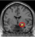 This is an MR-image of amygdala activity while playing the Ultimate Game.