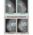 These are mammograms of estrogen-receptor positive breast tumors before and after 16 weeks of aromatase inhibitor therapy. The top two images show a tumor that responded to the treatment and regressed. The bottom two images show a tumor that was resistant to the treatment and stayed about the same size. Ellis hopes whole-genome analysis will help explain drug-resistance so that new treatments can be found.