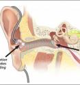 The ADEL(TM), which looks like a tiny ear-sealing balloon, is a sacrificial membrane that disrupts excessive pressure waves, protecting the ear drum when in-ear listening devices are used.