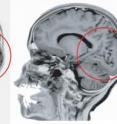 On the left, the occipital region of a normal human brain is circled. On the right, the same area of the brain of a subject with mutation of LAMC3 gene
is smooth, and lacks normal folds and convolutions.
