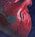 Engineers at Brown University have created a nanopatch for the heart that tests show restores areas that have been damaged, such as from a heart attack.