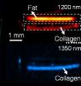 Researchers have developed a new type of imaging technology to diagnose cardiovascular disease and other disorders by measuring ultrasound signals from chemical bonds in molecules exposed to a pulsing laser. This "vibrational photoacoustic" image shows plaque in an arterial wall.