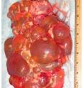 Cysts riddle a kidney from a patient with polycystic kidney disease.