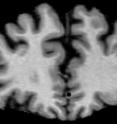 This is an MRI scan of a 79-year-old male human brain. This image shows an extreme amount of brain shrinkage than a a similar scan of a 24-year-old human male.