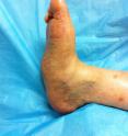 Photo of patient with Charcot foot, a syndrome described in a new journal article by Dr. Lee C. Rogers at Valley Presbyterian Hospital in Van Nuys, CA. Charcot foot syndrome causes the bones in the foot to soften and break, often resulting in amputation.