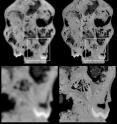 This image shows a comparison of a classical computer tomography (CT) scan (left) with a scan using synchrotron microtomography at the ESRF (right). The much higher resolution and contrast are clearly visible. The lower part depicts a zoom-in view of an area which on the upper part is indicated with a square. This area includes a tooth and a cavity in the skull.