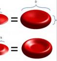 Top row: Model of a healthy red blood cell with a normal dimple. Bottom row: Model of a deflated red blood cell with an abnormal dimple. Top row: Model of a healthy red blood cell with a normal dimple. Bottom row: Model of a deflated red blood cell with an abnormal dimple.