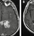 An MRI depicts a glioblastoma (center white mass) before treatment with the drug erlotinib (A) and after (B). An MRI depicts a glioblastoma (center white mass) before treatment with the drug erlotinib (A) and after (B).