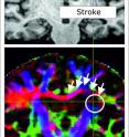 Stroke damage (white circle) can destroy the communication channels within the brain. This depiction of stretches of fibers show that the damage can also affect fibers between the hemispheres (red) which whither in the course of the illness, thus impeding the exchange of information between the hemispheres.
