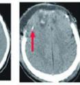 These are CT scans of two patients with traumatic brain injury. Red arrows point to the catheter tips used to collect samples of brain fluid by microdialysis. Though both patients are injured, only the CT scan on the right shows an obvious problem (top of image). While CT scans are good at finding problems that are immediately life-threatening (such as a hemorrhage that requires surgery), they do not always reflect the amount of axonal injury. Measuring tau protein by microdialysis and special imaging techniques, such as diffusion tensor imaging, may help to better assess the extent of injury to the brain's fragile axons.