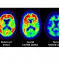 PET scans reveal amyloid plaques, which appear as warm colors such as red, yellow and orange. On the left is a patient with Alzheimer's disease, and on the right is a person with no detectable amyloid deposits in the brain. The middle scan is of a normal person with no symptoms of cognitive problems,  but with evident levels of amyloid plaque in the brain.
