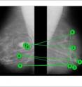 In the study, gaze direction was used to nudge novices into following an expert radiologist’s scanpath (a simplified version of which is shown in green) as they looked at a mammogram. A potential tumor is circled in red.