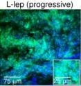 Skin biopsy sections from L-lep (progressive disease) and T-lep (limited disease) show the micro RNA hsa-mir-21 identified through a green fluorescent stain and skin nuclei identified with a blue fluorescent stain. Note more occurrence of hsa-mir-21 in progressive versus limited disease.