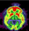 The PET image of the brain shows a build up of amyloid deposits (highest amounts in yellow and red) in a patient with Alzheimer's disease.
