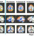 Brain scans show differences among high school football players in a two-year study that suggests concussions are likely caused by many hits over time and not from a single blow to the head, as commonly believed.