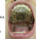 The circuitry for the new intraoral Tongue Drive System developed at Georgia Tech is embedded in this dental retainer worn in the mouth (right). The system interprets commands from seven different tongue movements to operate a computer (left) or maneuver an electrically powered wheelchair.