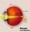 This is a diagram of myopia in the human eye.