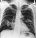This is an X-ray image of the chest with growth on the left side of the lung.