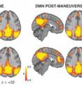 This image, from a Brigham and Women's Hospital study, shows the Default Mode Network in patients with chronic low back pain (cLBP) and in healthy subjects (CONTROLS) before and after  maneuvers which are painful for the cLBP but not for the CONTROLS.  
Notice that after the maneuvers, the cluster in the front of the brain is disrupted (it shows less color) in the cLBP patients, but not in the CONTROLS.
This supports the study finding that pain changes brain connectivity.