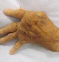 This is the hand of someone affected by rheumatoid arthritis.