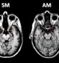 Researchers at the University of Iowa show that the human brain has new regions that sense internally derived fear. The finding comes from tests the team conducted of three women with significant damage to the amygdala (shown in the brain scans by red-dashed circles), which registers fear from external dangers.
