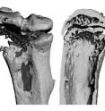 Investigational cancer drugs, IAP antagonists, may increase the risk of tumors spreading to bone. Tumors often cause bone loss, but IAP antagonist treatment accelerates the problem. The images show a bone with a tumor from a mouse treated with IAP antagonist BV6. The bone destruction is substantial, with gaping holes (left) and near total loss of the interior spongy bone (right).